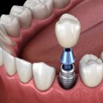 dental implants, dental crowns, Family Dentistry of Euless, dental treatment options, oral health, Euless TX dentist, dental care, tooth replacement options