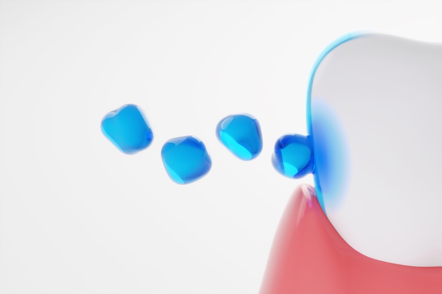 professional fluoride treatment